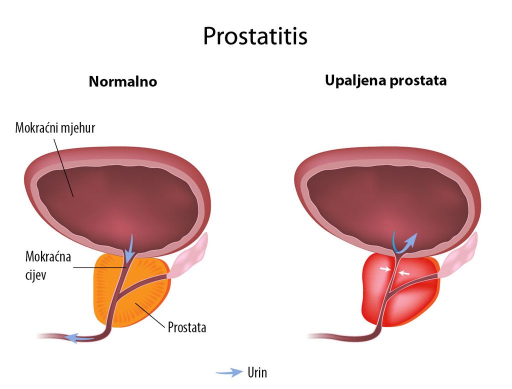Uno de los métodos más eficaces para tratar la prostatitis